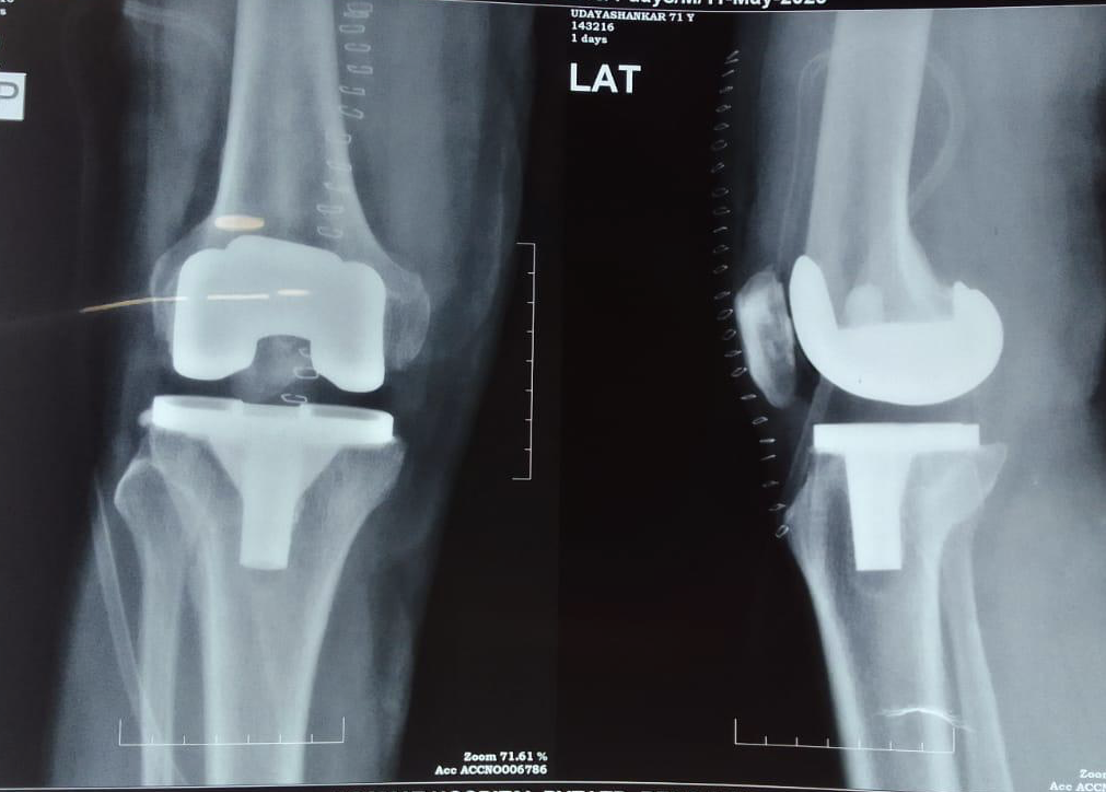 Knee Replacement — after 1